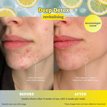 Load image into Gallery viewer, Bye Bye Breakouts Face Mask Kit
